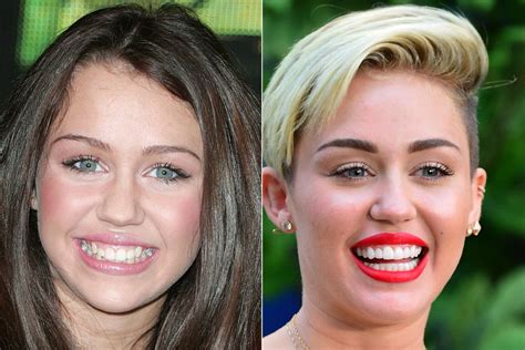 famous teeth before and after